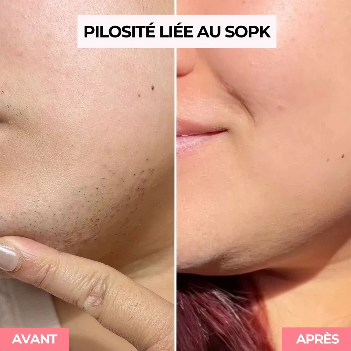 Solendda épilateur à lumière pulsée